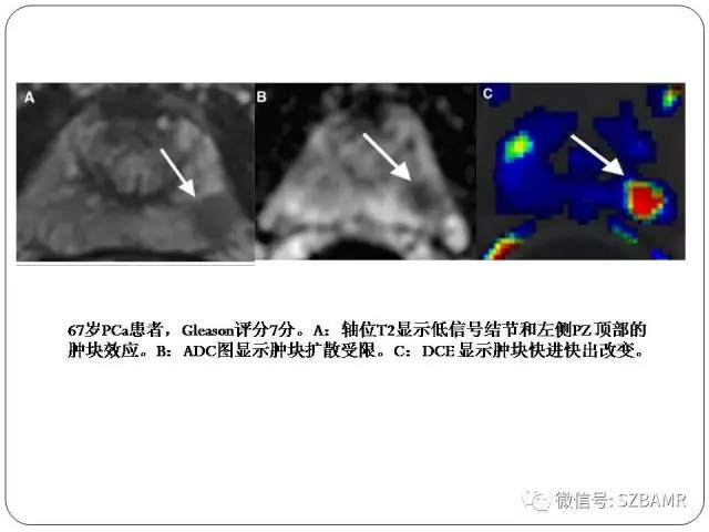 【PPT】前列腺周围带扩散受限的良性病变：诊断与鉴别诊断