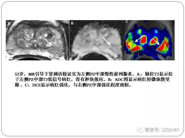 【PPT】前列腺周围带扩散受限的良性病变：诊断与鉴别诊断