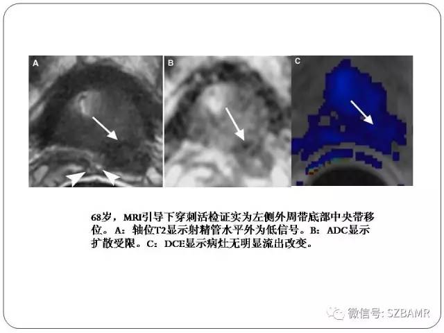 【PPT】前列腺周围带扩散受限的良性病变：诊断与鉴别诊断