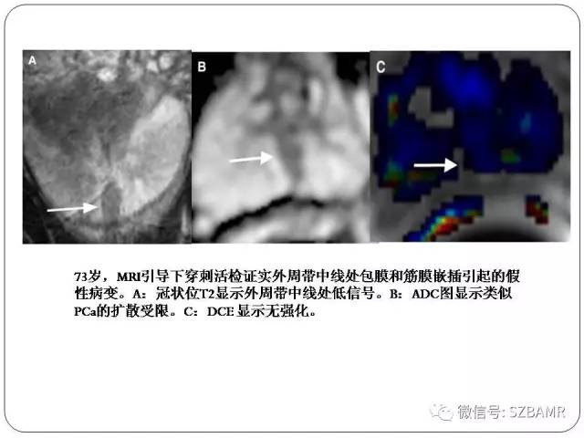 【PPT】前列腺周围带扩散受限的良性病变：诊断与鉴别诊断