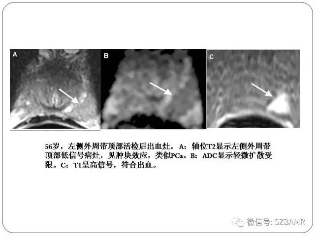 【PPT】前列腺周围带扩散受限的良性病变：诊断与鉴别诊断