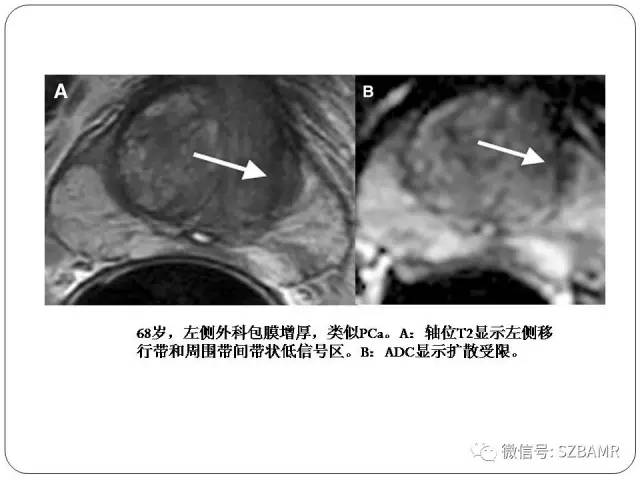 【PPT】前列腺周围带扩散受限的良性病变：诊断与鉴别诊断