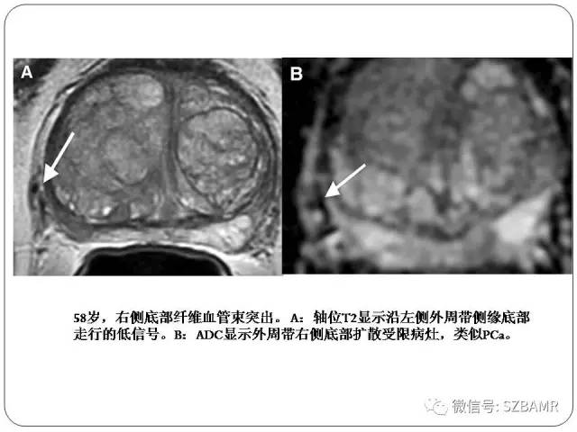 【PPT】前列腺周围带扩散受限的良性病变：诊断与鉴别诊断