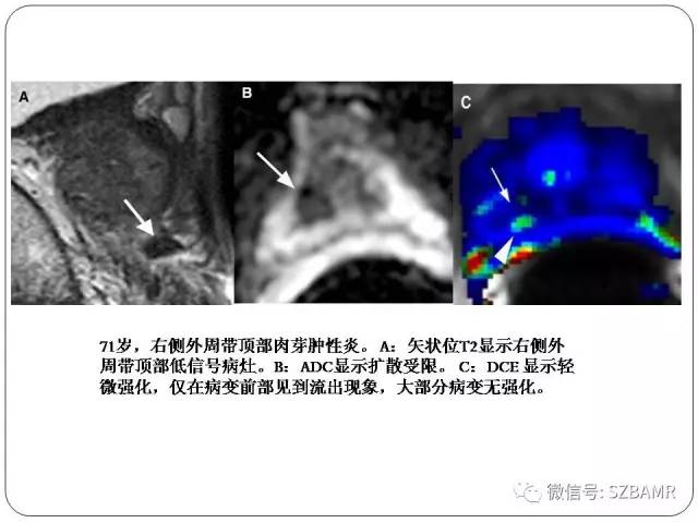 【PPT】前列腺周围带扩散受限的良性病变：诊断与鉴别诊断