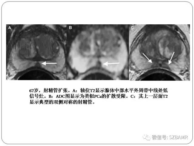 【PPT】前列腺周围带扩散受限的良性病变：诊断与鉴别诊断