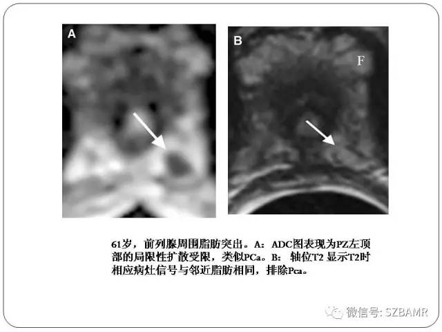 【PPT】前列腺周围带扩散受限的良性病变：诊断与鉴别诊断