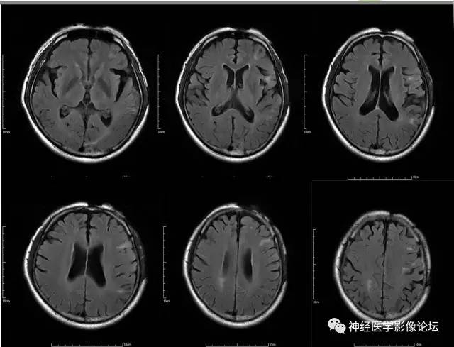 【病例】脑囊虫病1例MR影像表现