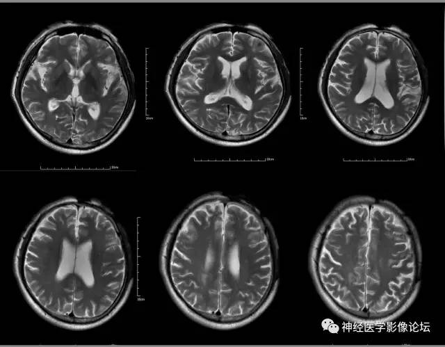 【病例】脑囊虫病1例MR影像表现