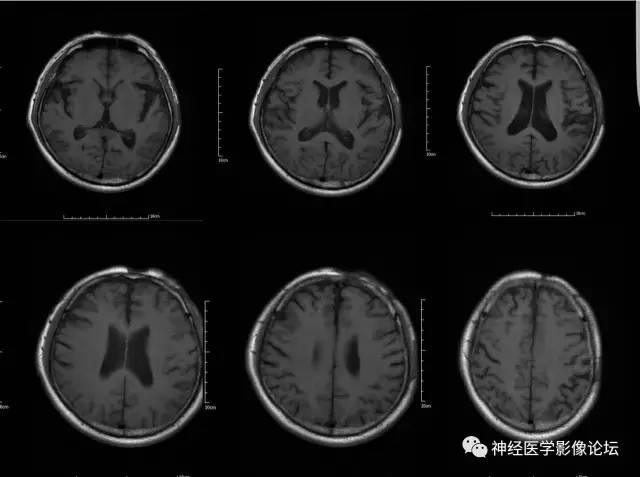 【病例】脑囊虫病1例MR影像表现
