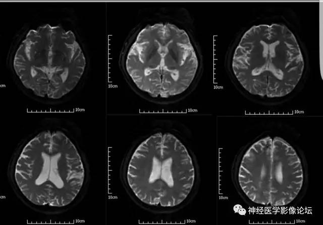 【病例】脑囊虫病1例MR影像表现