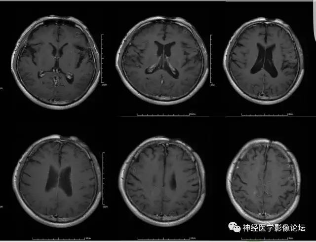 【病例】脑囊虫病1例MR影像表现