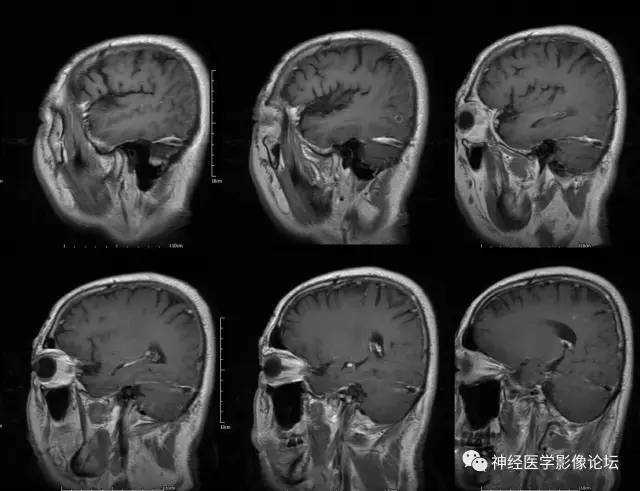 【病例】脑囊虫病1例MR影像表现