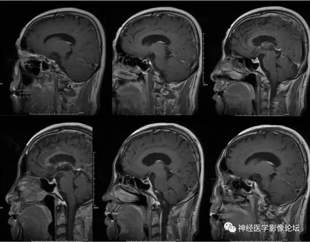 【病例】脑囊虫病1例MR影像表现