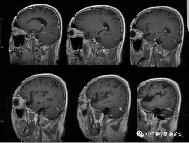 【病例】脑囊虫病1例MR影像表现