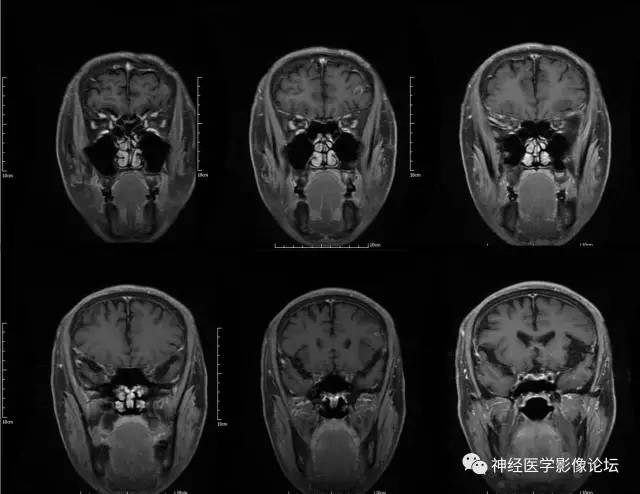 【病例】脑囊虫病1例MR影像表现