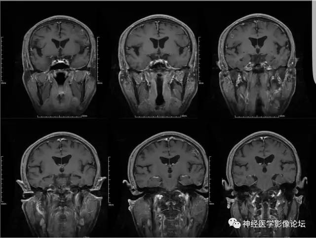 【病例】脑囊虫病1例MR影像表现