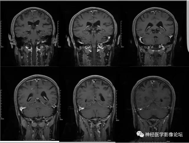 【病例】脑囊虫病1例MR影像表现