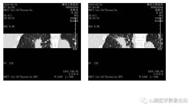 【病例】右肺结核——支气管树爬行征 【病例】右肺结核——支气管树爬行征