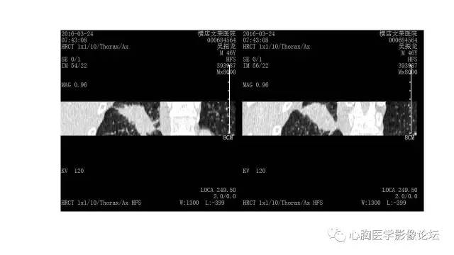 【病例】右肺结核——支气管树爬行征 【病例】右肺结核——支气管树爬行征