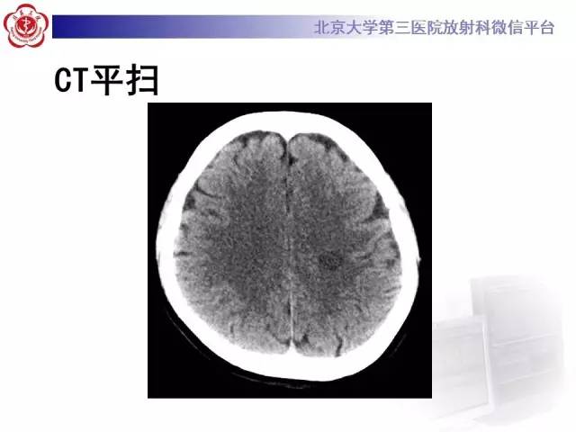 【病例】同心圆硬化1例CT及MR影像表现