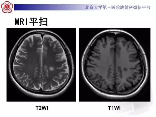 【病例】同心圆硬化1例CT及MR影像表现