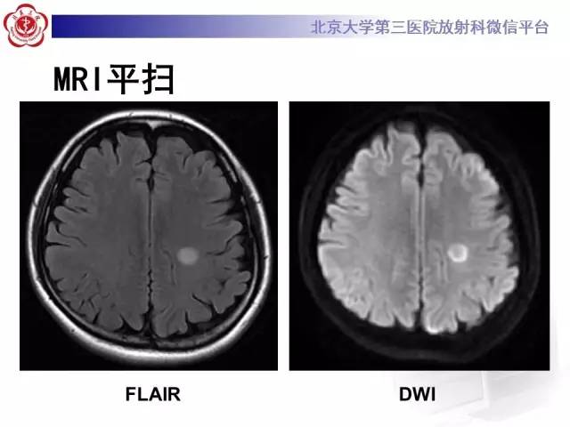 【病例】同心圆硬化1例CT及MR影像表现