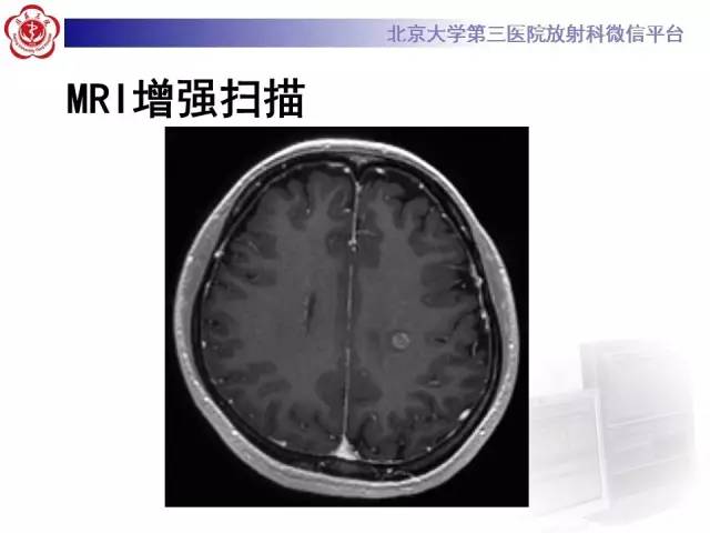【病例】同心圆硬化1例CT及MR影像表现