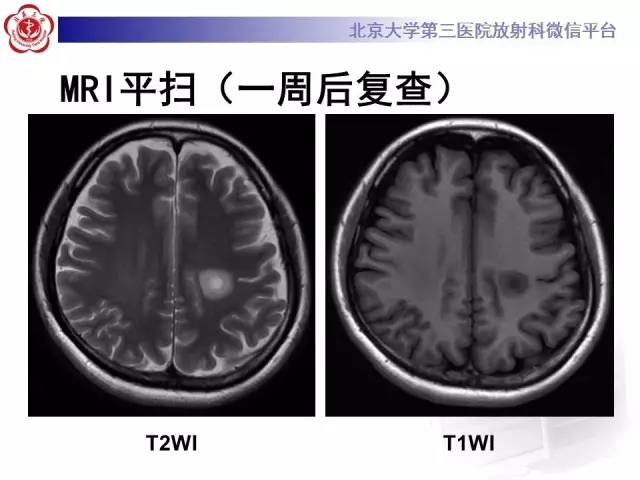 【病例】同心圆硬化1例CT及MR影像表现