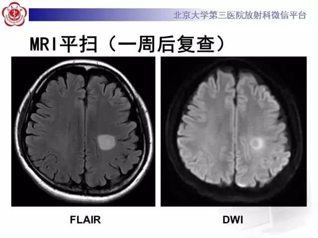 【病例】同心圆硬化1例CT及MR影像表现