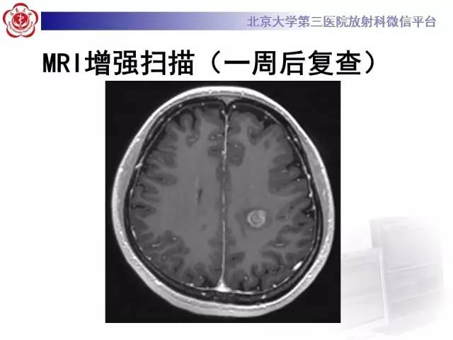 【病例】同心圆硬化1例CT及MR影像表现