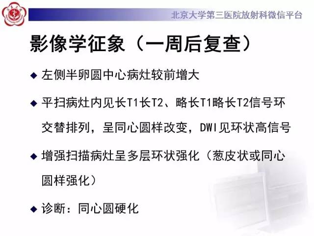 【病例】同心圆硬化1例CT及MR影像表现