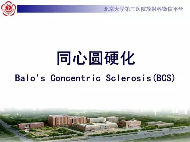 【病例】同心圆硬化1例CT及MR影像表现