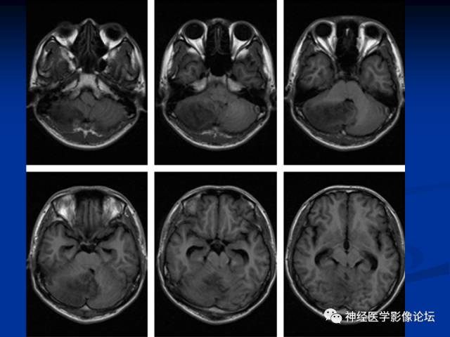 【病例】右小脑囊虫病一例MR