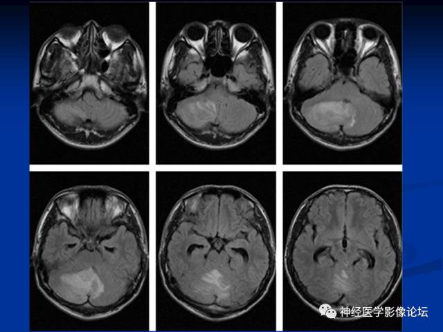 【病例】右小脑囊虫病一例MR