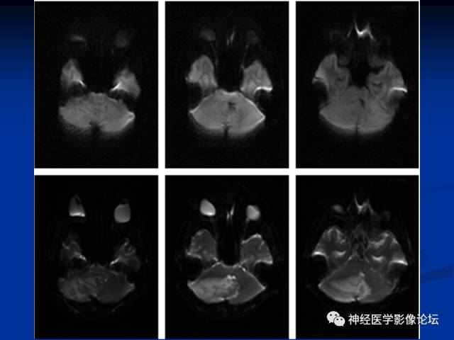 【病例】右小脑囊虫病一例MR