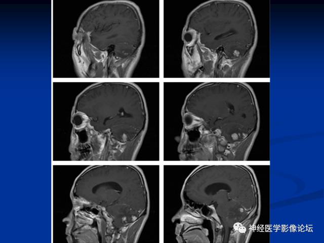 【病例】右小脑囊虫病一例MR