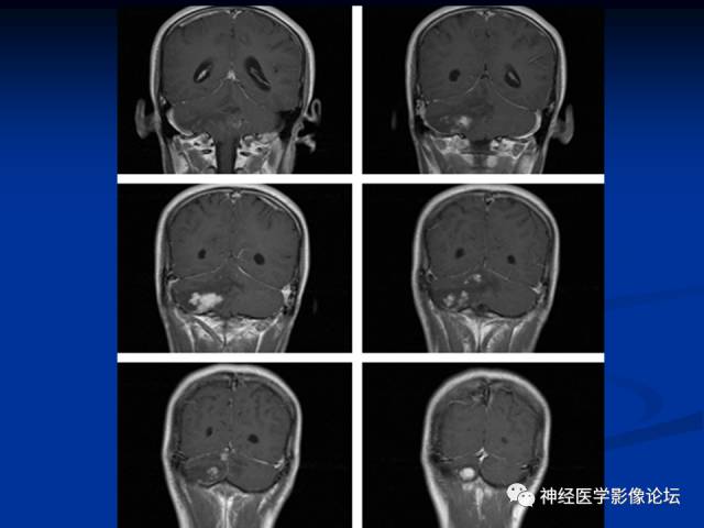 【病例】右小脑囊虫病一例MR