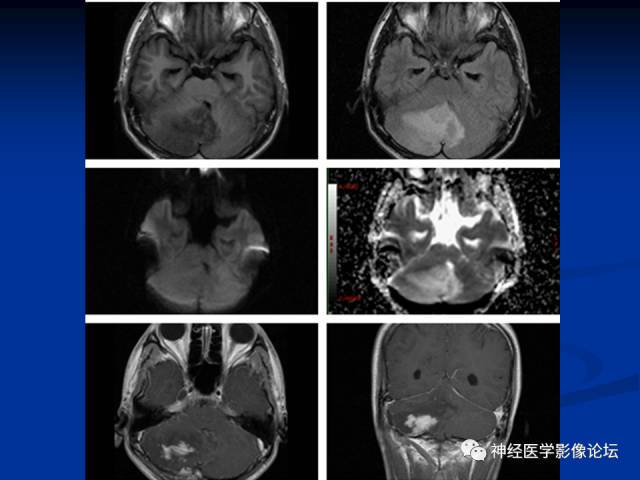 【病例】右小脑囊虫病一例MR