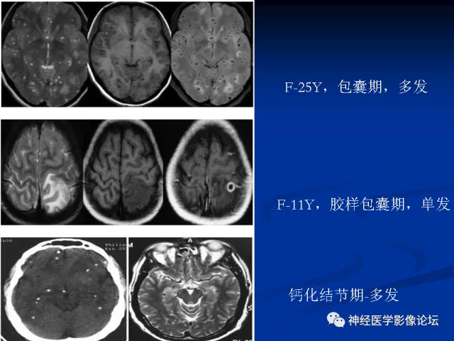 【病例】右小脑囊虫病一例MR