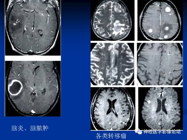 【病例】右小脑囊虫病一例MR