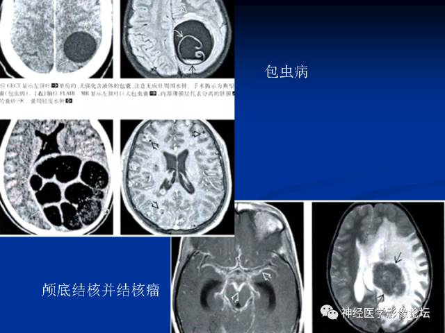 【病例】右小脑囊虫病一例MR
