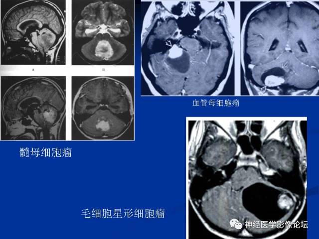【病例】右小脑囊虫病一例MR