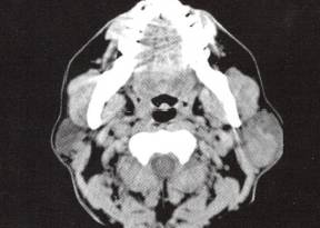 【病例】腮腺腺淋巴瘤1例CT影像表现 【病例】腮腺腺淋巴瘤1例CT影像表现