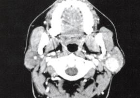 【病例】腮腺腺淋巴瘤1例CT影像表现 【病例】腮腺腺淋巴瘤1例CT影像表现