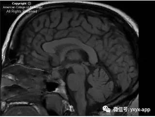【病例】淋巴细胞性垂体炎1例MR影像诊断分析