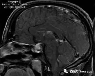【病例】淋巴细胞性垂体炎1例MR影像诊断分析