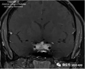 【病例】淋巴细胞性垂体炎1例MR影像诊断分析