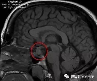 【病例】淋巴细胞性垂体炎1例MR影像诊断分析