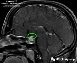 【病例】淋巴细胞性垂体炎1例MR影像诊断分析