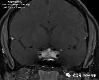 【病例】淋巴细胞性垂体炎1例MR影像诊断分析